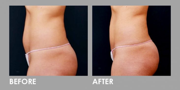 Before & After Vanquish Fat Removal Treatment