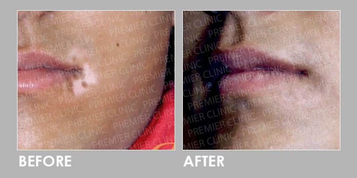 Vitiligo Removal Before After