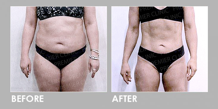 Before & After Oral Weight Loss Slimming Pills