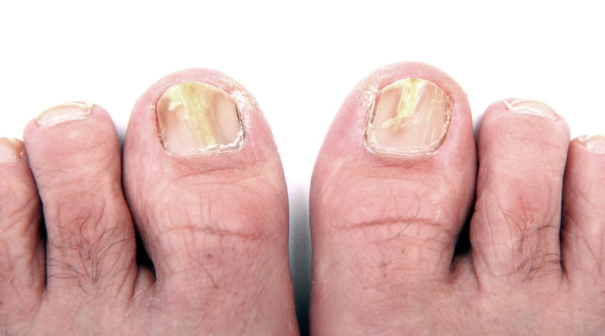 Nail Fungal Infection Laser 