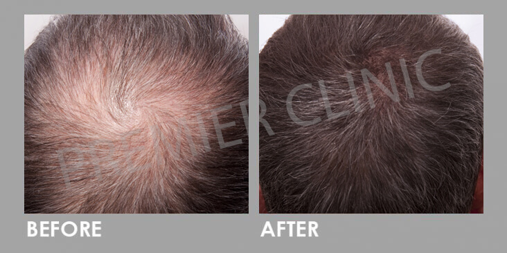 Mesotherapy For Hair Loss