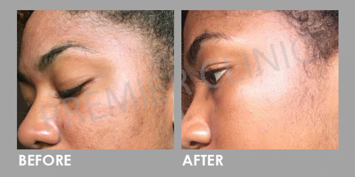 Before & After Microdermabrasion Facial Treatment