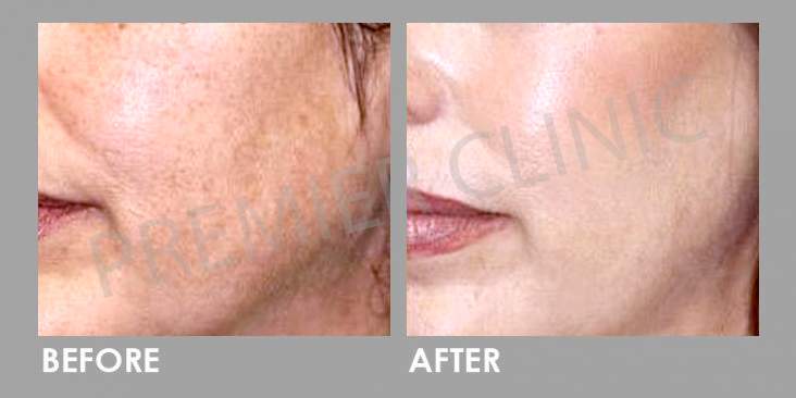 Before & After Carbon Laser Peel Treatment