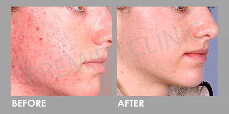 Before & After Microdermabrasion Facial Treatment