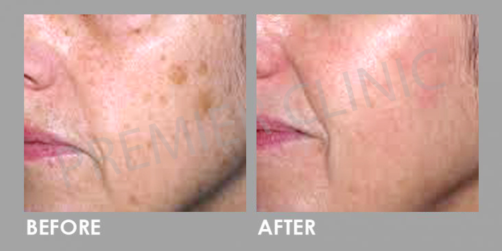Before & After Q-Switch Nd:YAG Laser