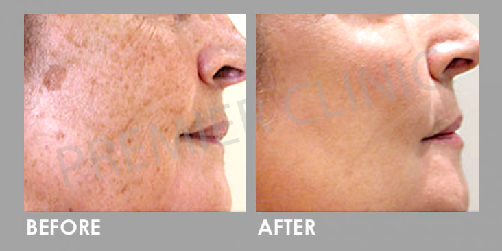 Before & After Q-Switch Nd:YAG Laser