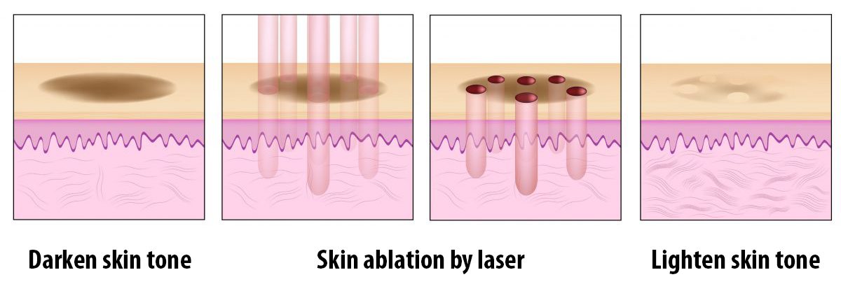 cel Integraal zelfstandig naamwoord Vagina Laser Whitening Treatment | Premier Clinic KL, Malaysia