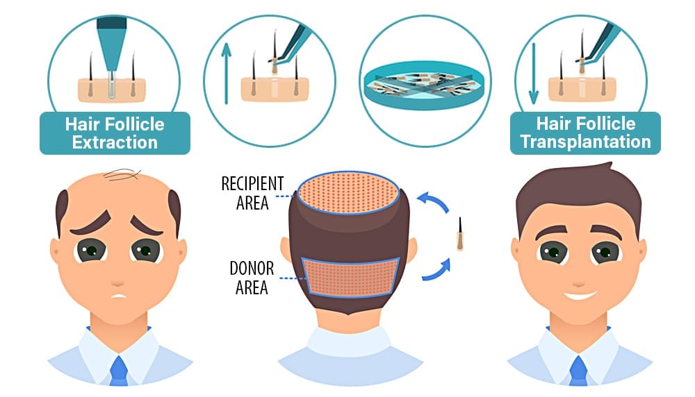 Premier FUE Hair Transplant