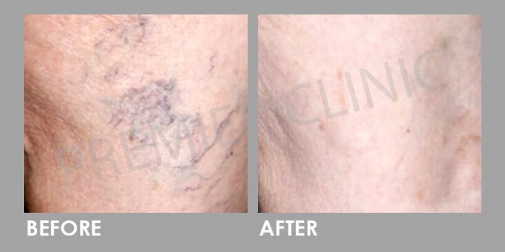 Fine Vein Removal Before After 01