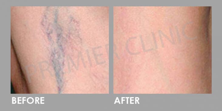 Fine Vein Removal Before After 02
