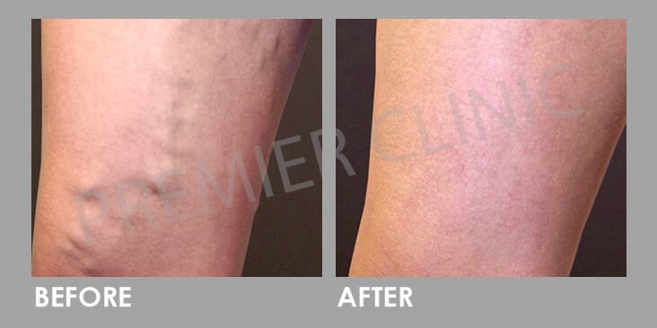 Fine Vein Removal Before After 03