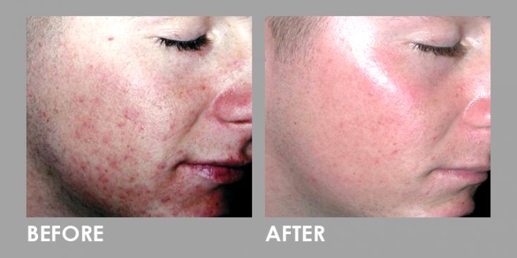 Before & After Premier LED Phototherapy