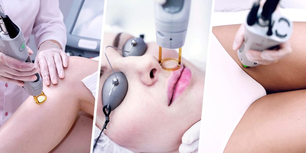 laser treatment for hair removal