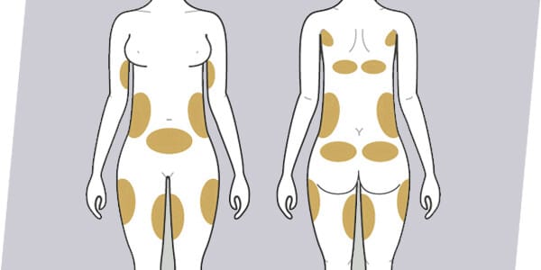 WHICH AREA CAN BE TREATED USING BODY CONTOURING TREATMENT