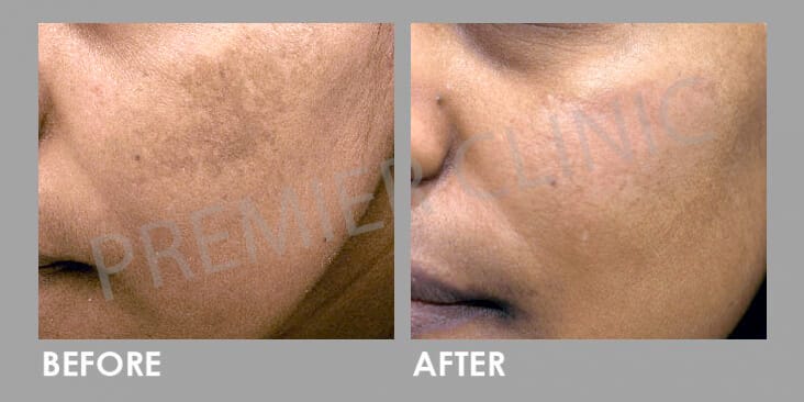 Pico Laser’s Acne Scar Treatment | Premier Clinic