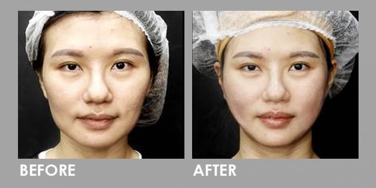 Before & After Thread Lift: Non-surgical Skin Lift