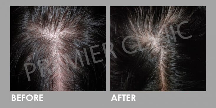 FUE Hair Transplant Before After 02