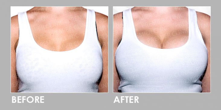 Breast Enlargement Before After