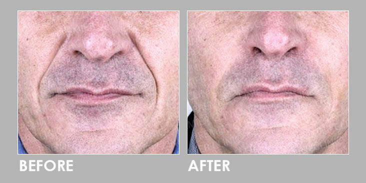Wrinkle Removal Laser Before & After