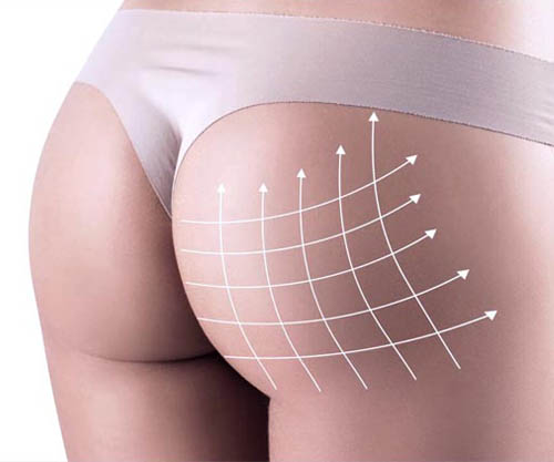 Non-Surgical Butt Lift More Effective