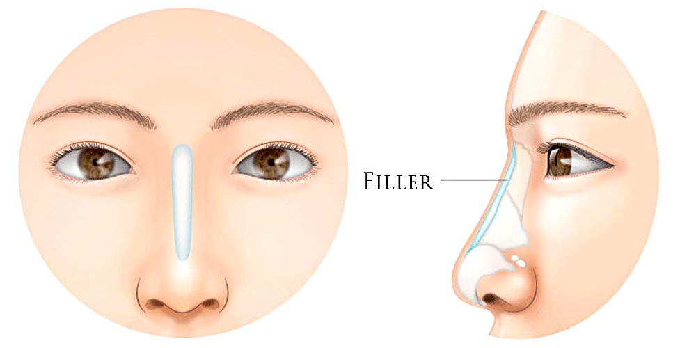 Non-Surgical Nose Job