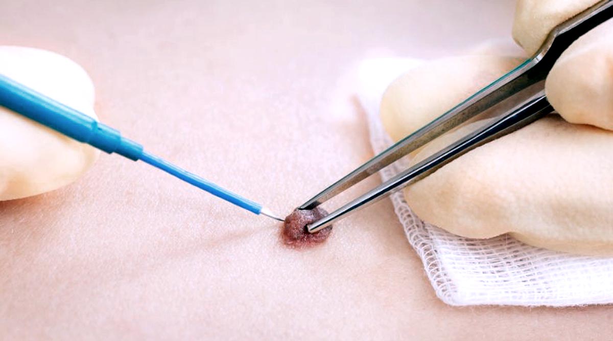 Electrosurgery: What is it, How does it Work, and What are the Benefits?