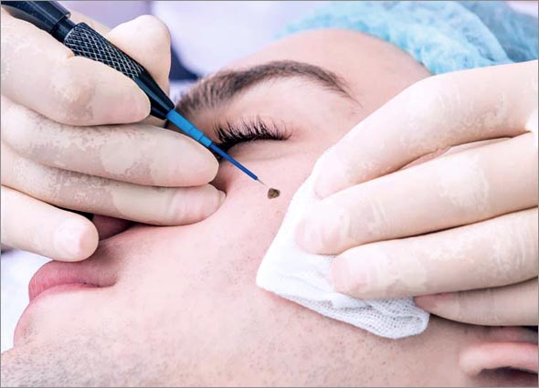 Thermal ElectroCautery Cervical For Skin & Dermatology Boil