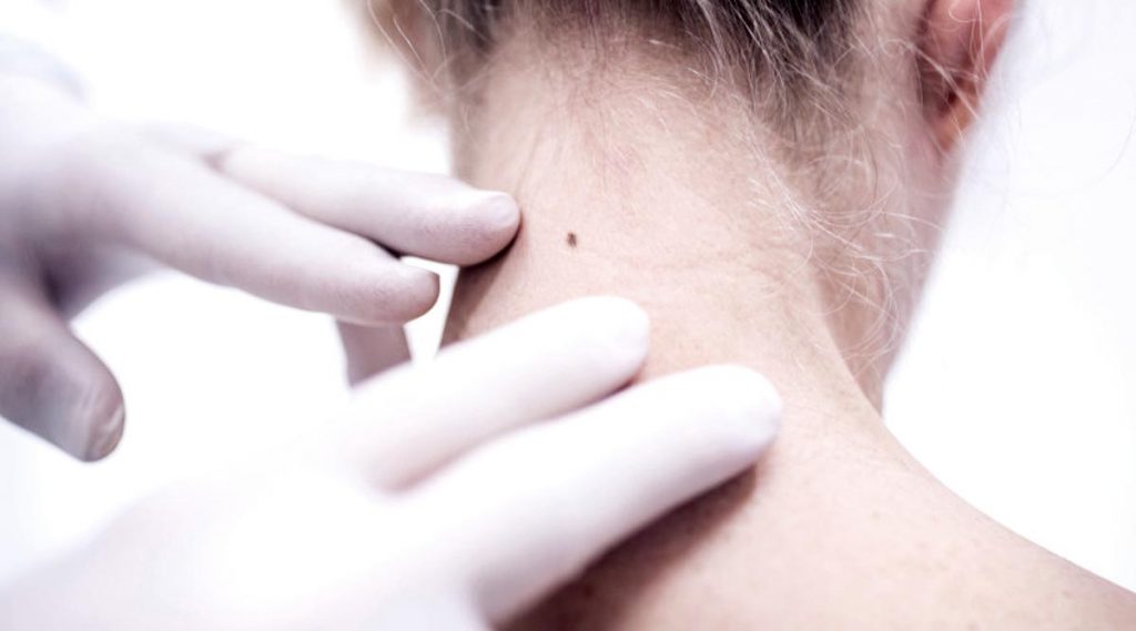 Electrocautery Milia Mole Skin Tags And Warts Removal