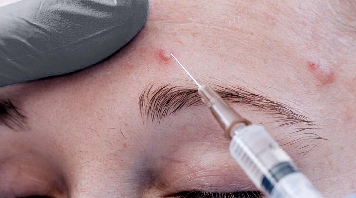 Intralesion Corticosteroid Injection