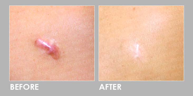 Keloid Laser Treatment Before After