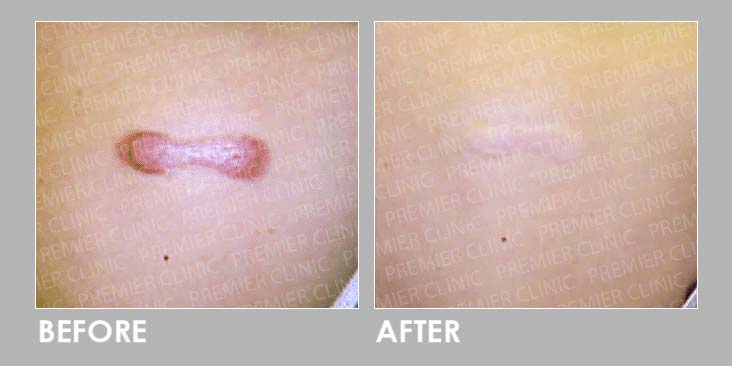 Keloid Laser Treatment Before After