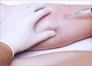 Sclerotherapy Injection