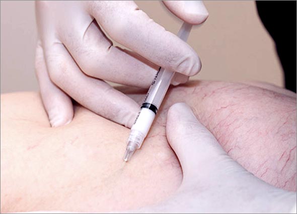 Sclerotherapy Injection