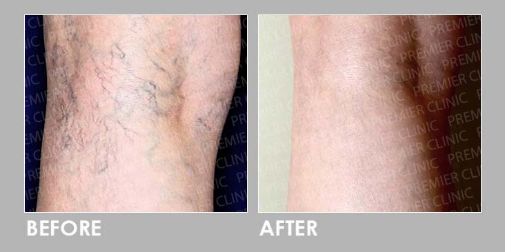Sclerotherapy Injection Before After