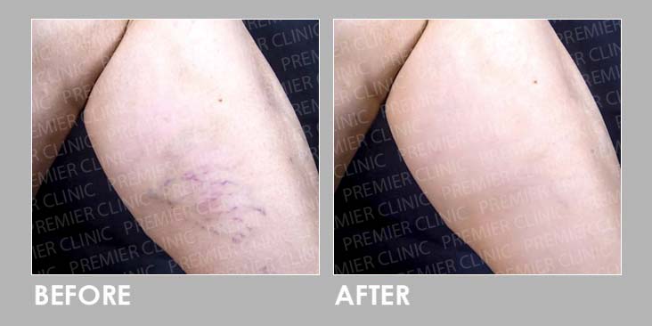 Sclerotherapy Injection Before After