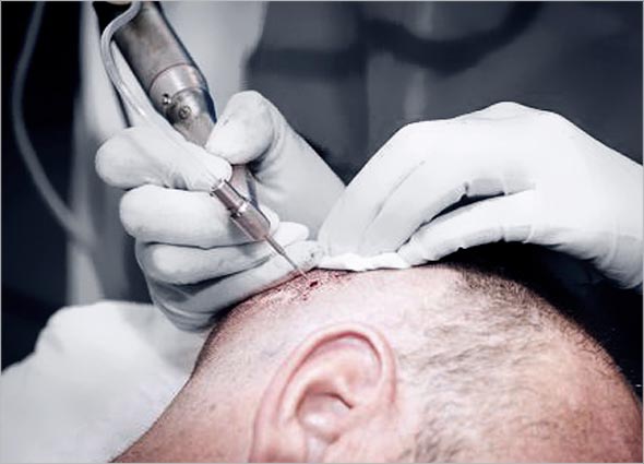 FUE Hair Transplant for Hair Loss