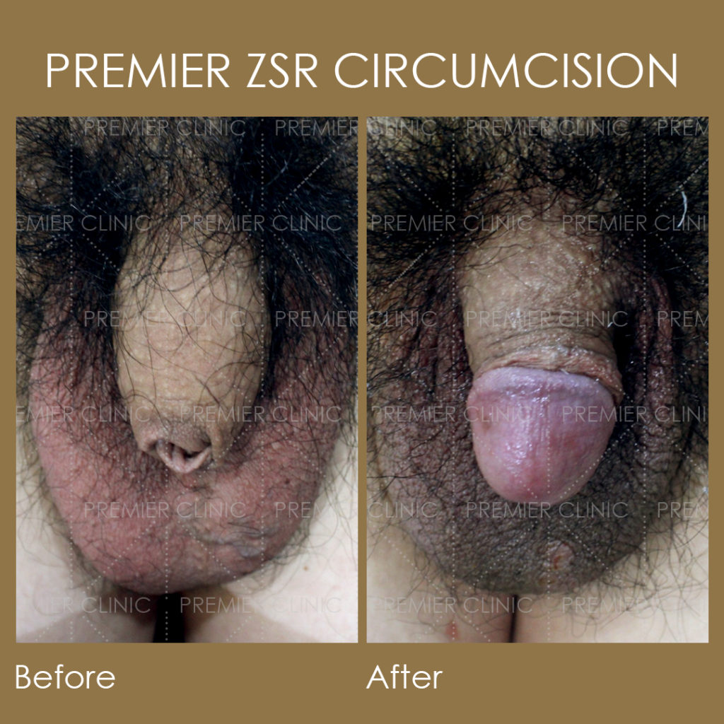 Premier ZSR Before & After