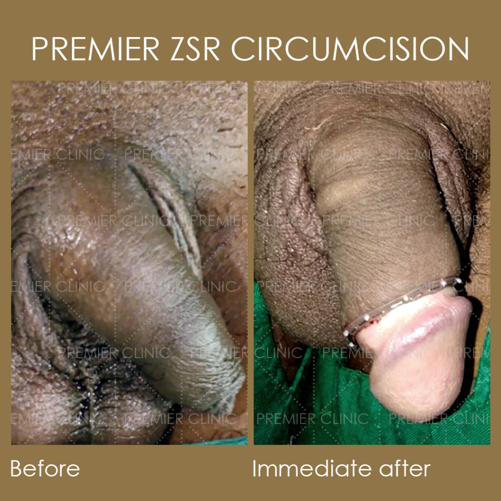 Premier ZSR Before & After