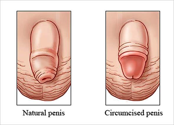 ZSR Circumcision at Premier Clinic