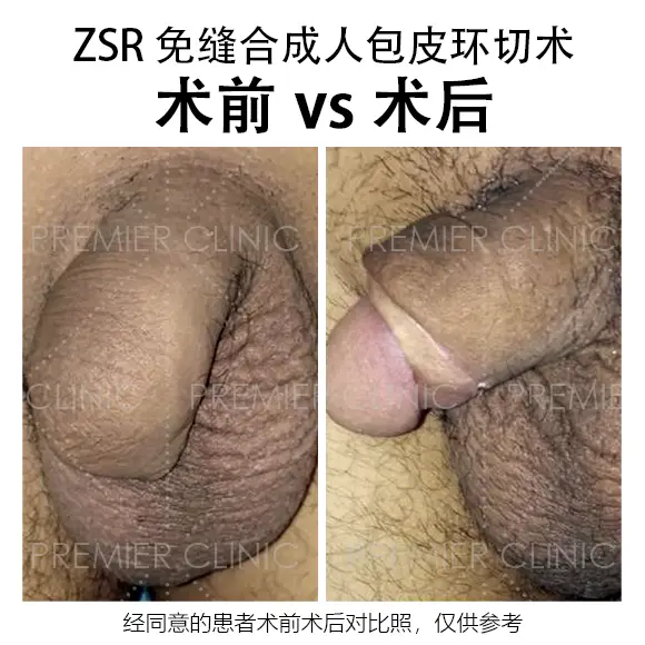 包皮环切术前 vs 术后