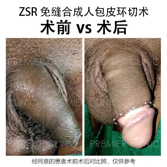 包皮环切术前 vs 术后