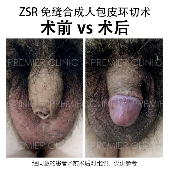 包皮环切术前 vs 术后