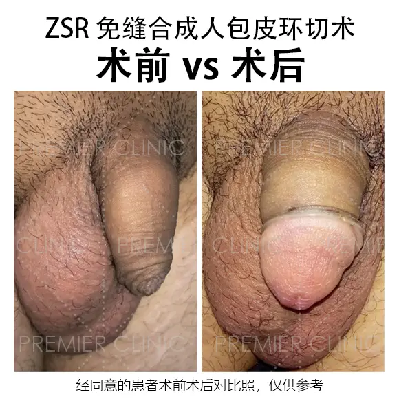 包皮环切术前 vs 术后