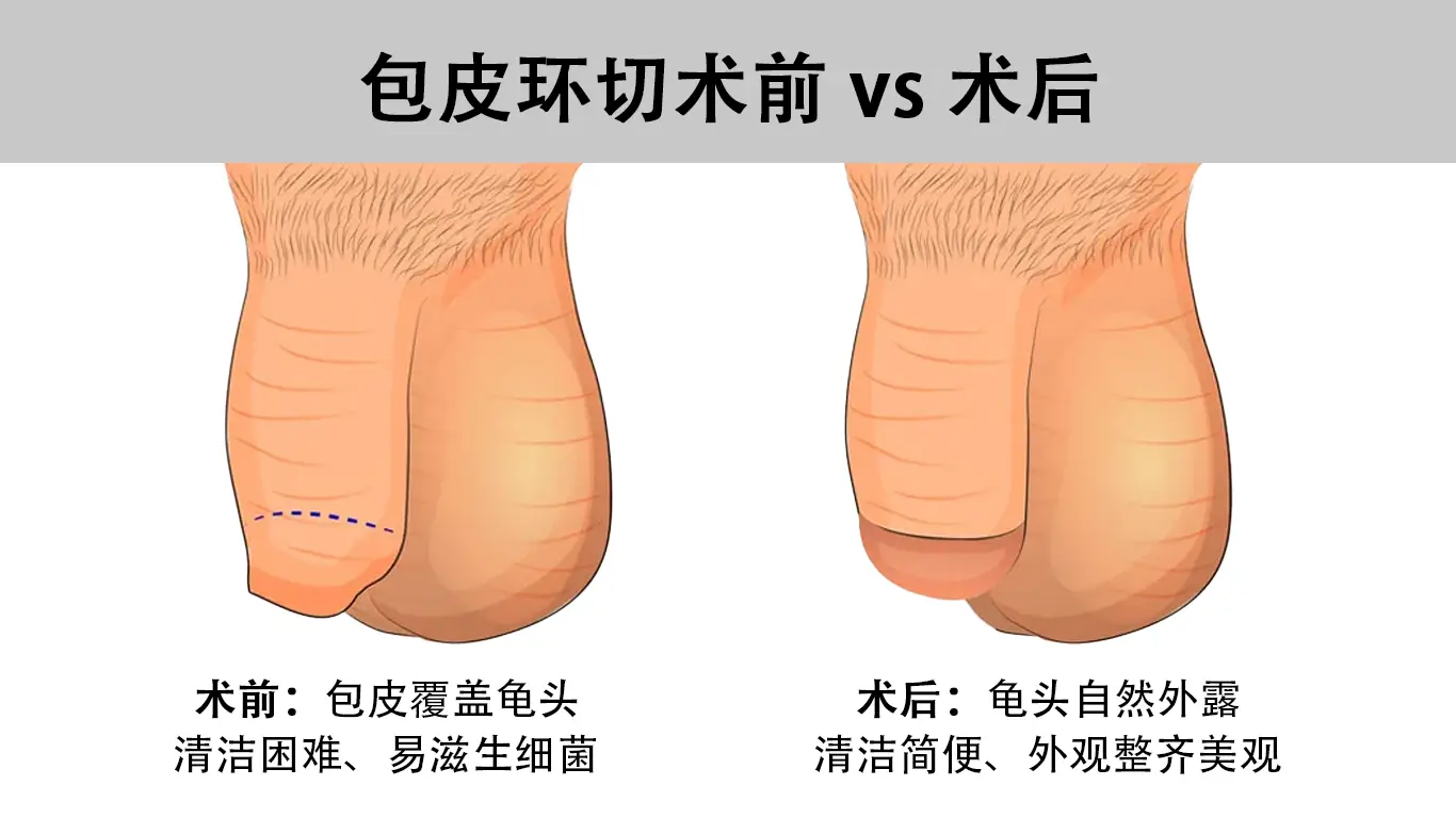 包皮环切术前 vs 术后