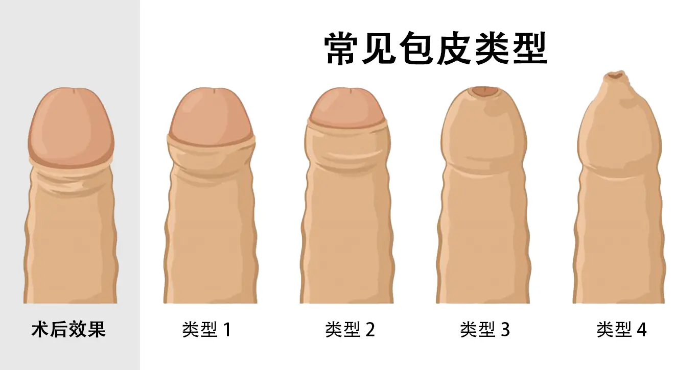常见包皮类型