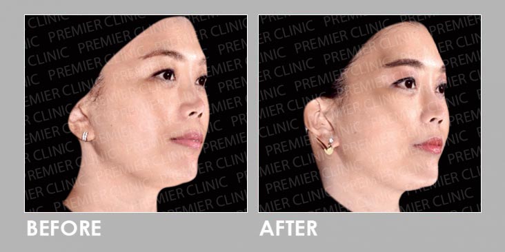 8cc Fillers Before & After