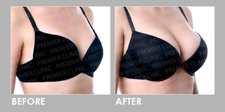 LipoFill Body Reshaping Before After