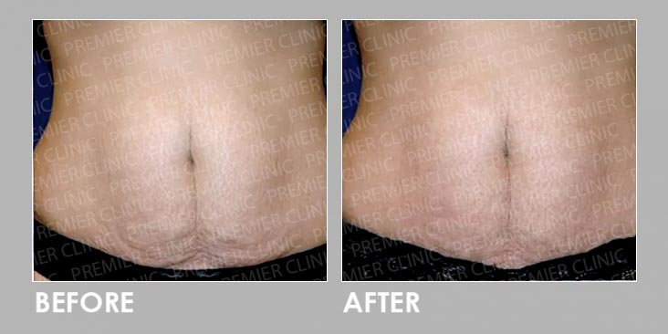 skin tightening & fat loss Before & After