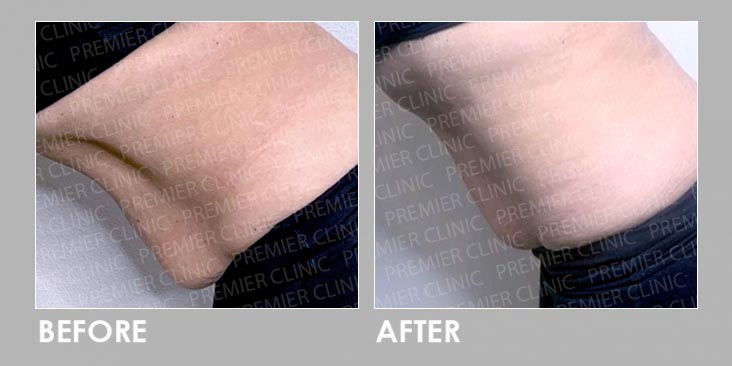 skin tightening & fat loss Before & After
