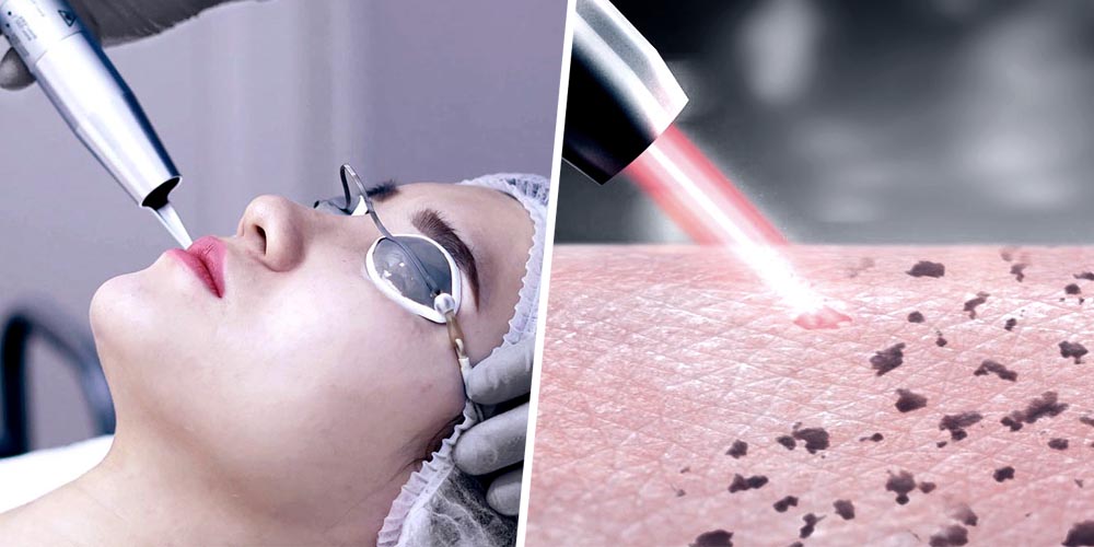 Premier Scar Removal - Laser